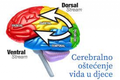 Cerebralno o&scaron;tećenje vida u djece - obavijest o tečaju